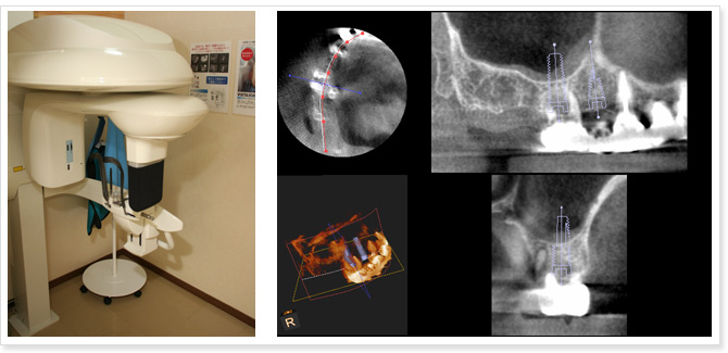 歯科用CT